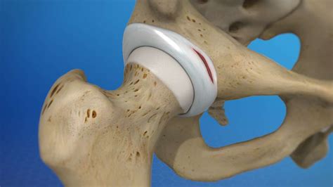 acetabular labral tear orthopedic test|acetabular labral tear surgery recovery.